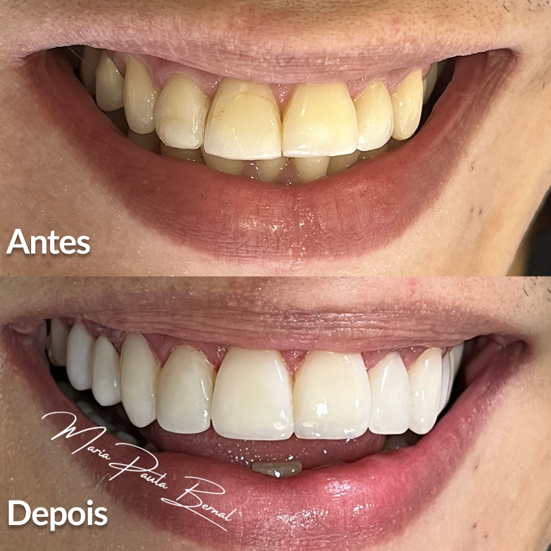 Transformação do sorriso com facetas de resina - Antes e Depois