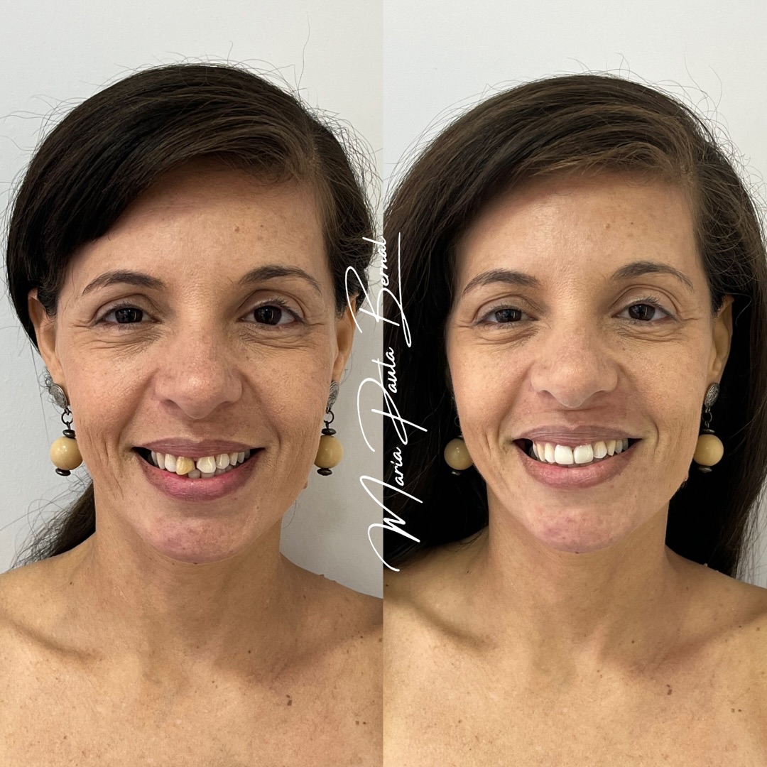 Transformação do sorriso - Paciente real
